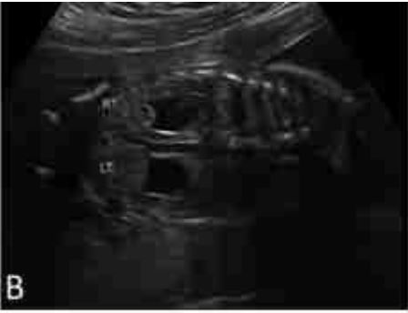 Εμβρυο 22+2 εβδομάδων . Εμφανίζεται διάταση 8 mm στον αριστερό νεφρό .